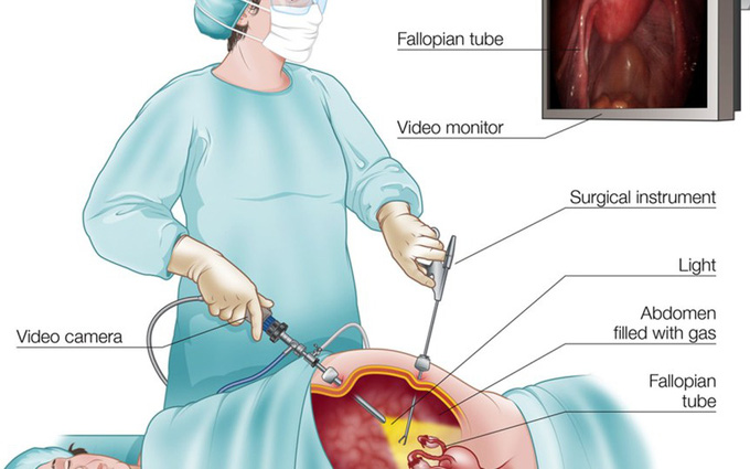 Trường hợp hoại tử rõ hoặc tháo xoắn buồng trứng không thể hồng trở lại thì bác sĩ sẽ chỉ định phẫu thuật cắt bỏ buồng trứng